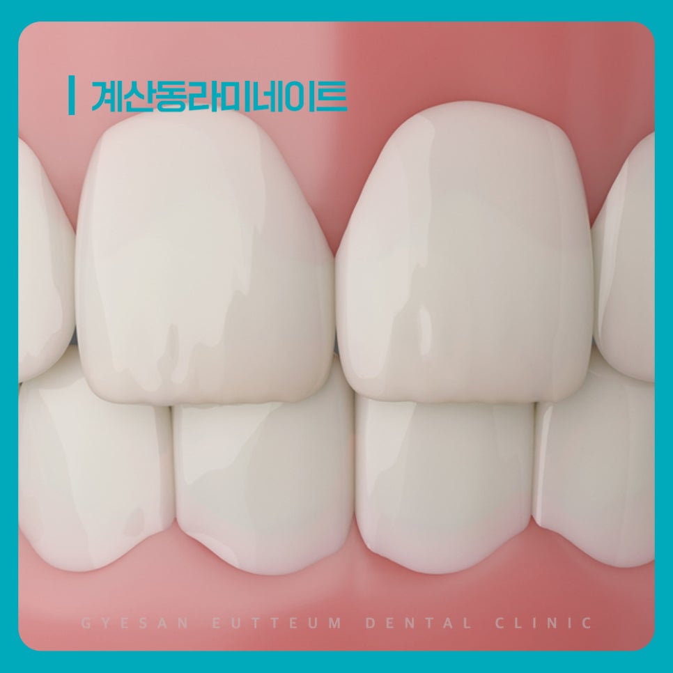 계산동치과 라미네이트 방법 치아 겉면 세라믹 부착으로 형태 색상 개선 방향