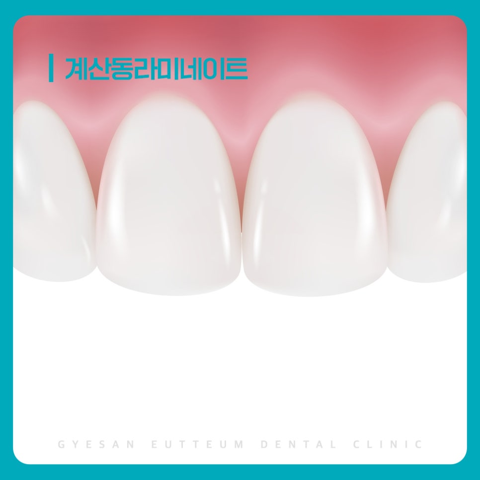 계산동치과 앞니 벌어짐 색 변화 치아 크기 차이 상황별 라미네이트 고려 기준