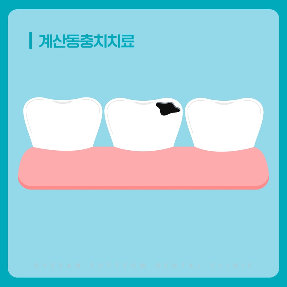 계양구치과 충치치료 통증 전 민감함과 단 음식 자극 반복 시 초기 상태 확인이 필요한 이유