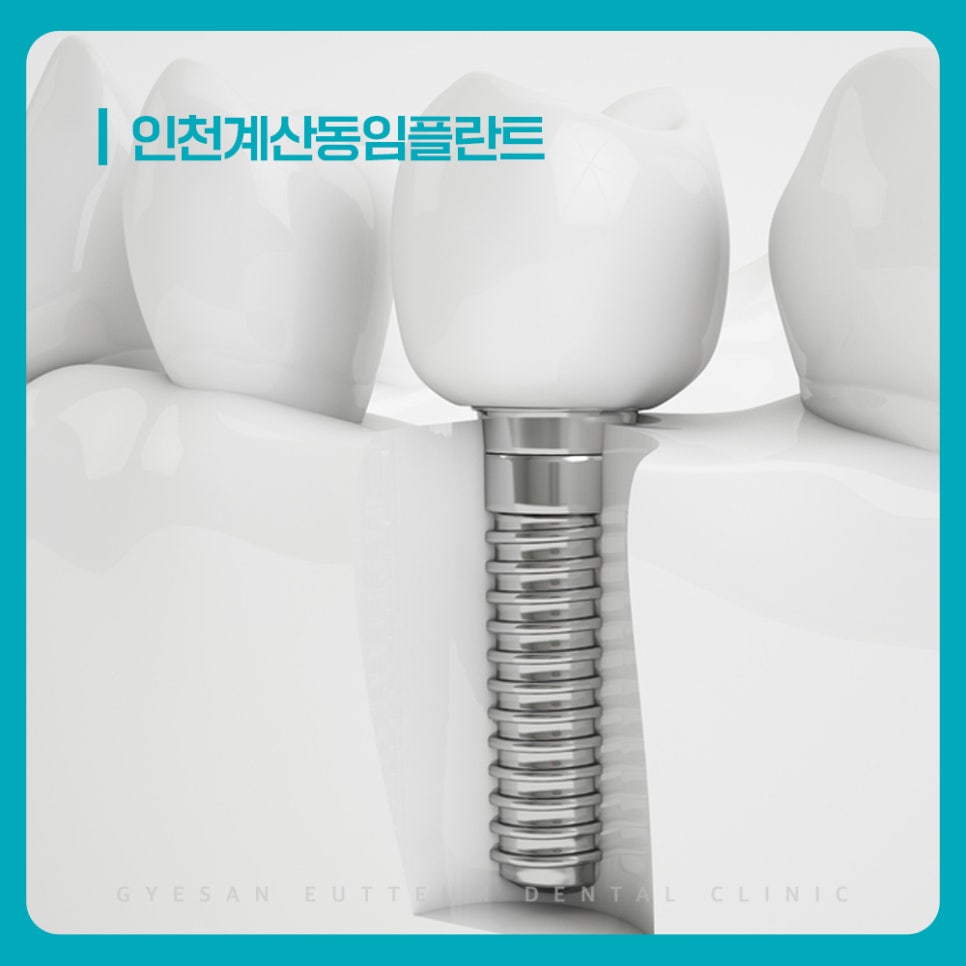 계산동치과 임플란트 잇몸뼈 결합이 식사 힘과 장기 사용 안정성에 중요한 이유