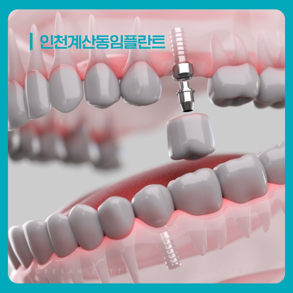 계산동치과 임플란트 식립 위치와 각도가 자연스러운 보철 사용에 미치는 영향과 결과