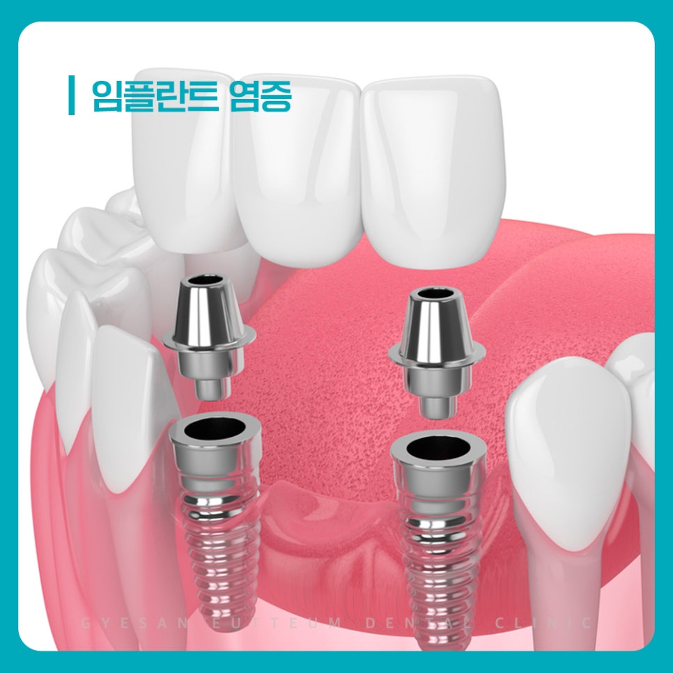 경인교대치과 임플란트 자연치아와 다른 구조 비교와 음식물 끼임 관리 방법