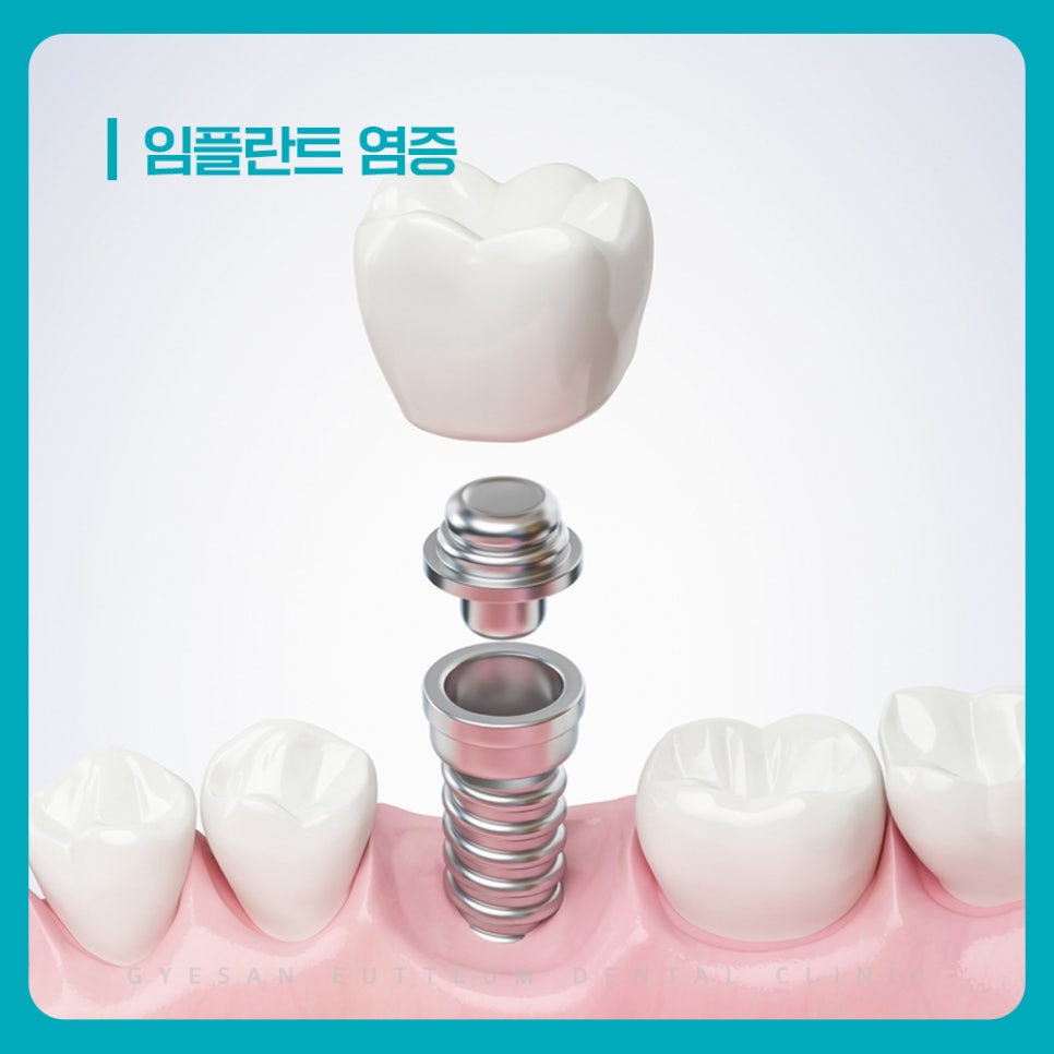 경인교대치과 임플란트 염증 양치 후 냄새 반복 시 현재 위생 상태 확인 방법