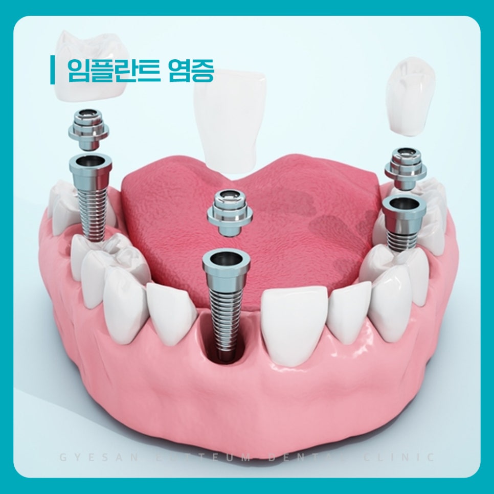 경인교대치과 임플란트 염증 단단한 음식 후 불편감 반복 시 확인 방법과 관리