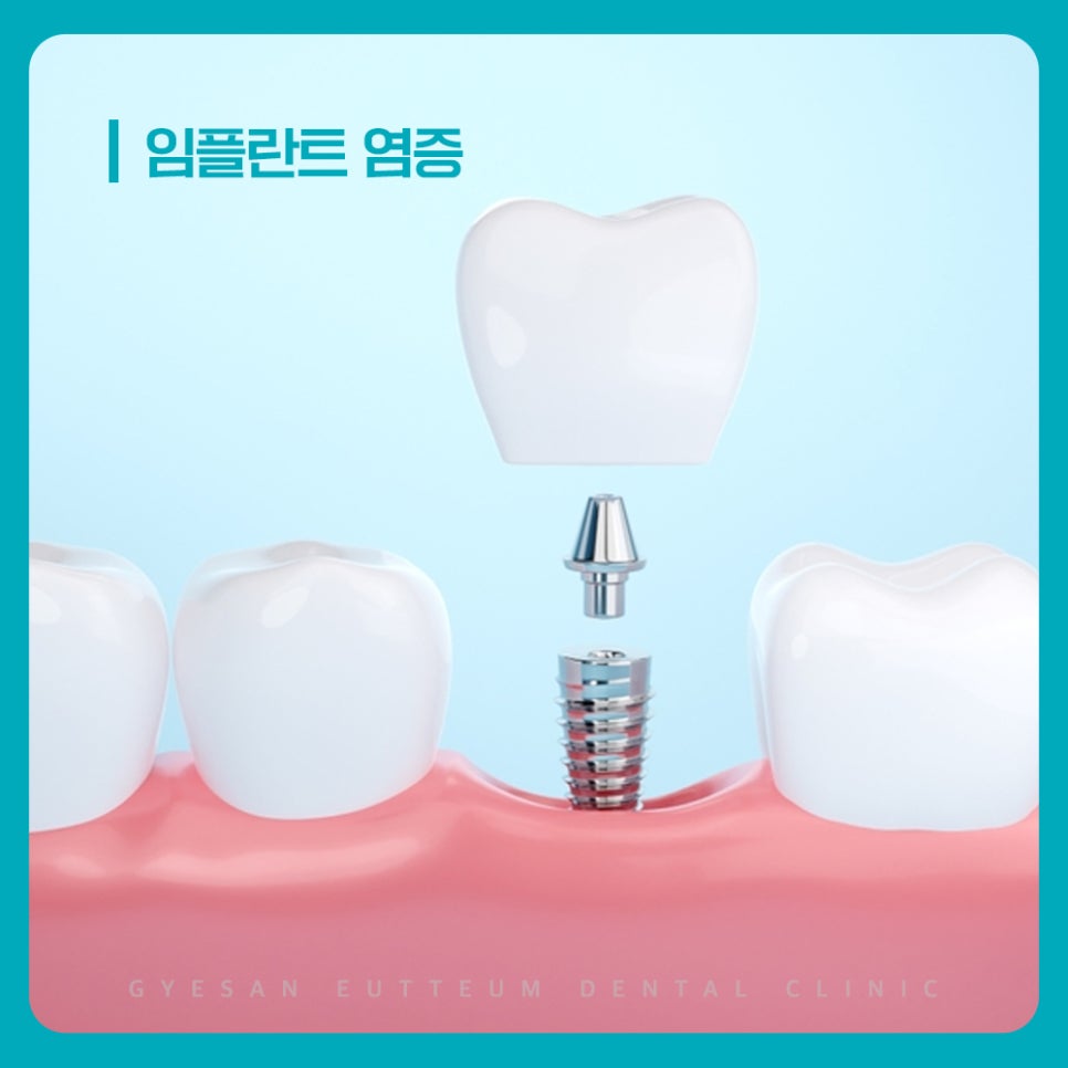 경인교대치과 임플란트 염증 통증 적은 초기 잇몸 붉어짐 붓기 확인 주의사항