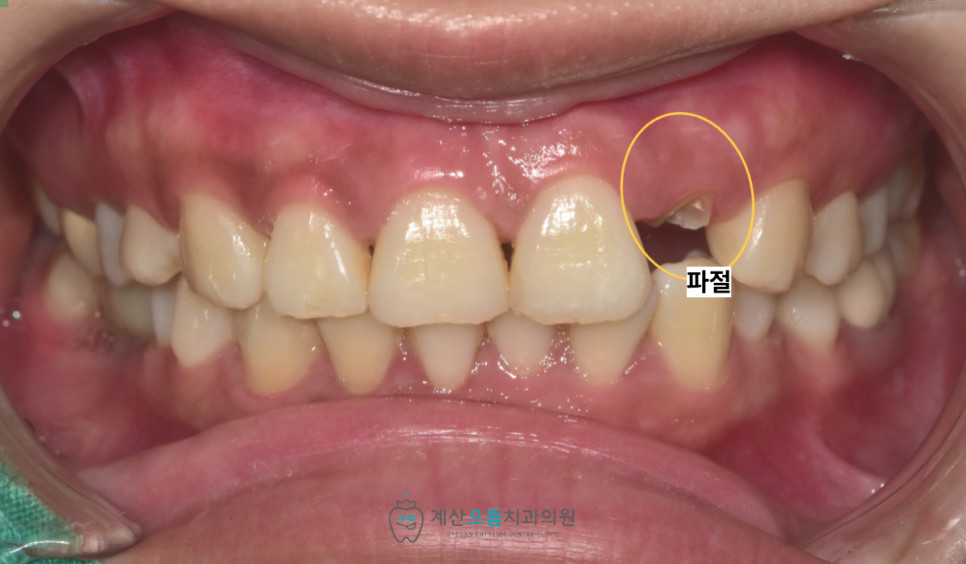 경인교대치과 앞니 잇몸뼈 두께가 얇아 흡수 위험이 큰 이유 임플란트 전 확인