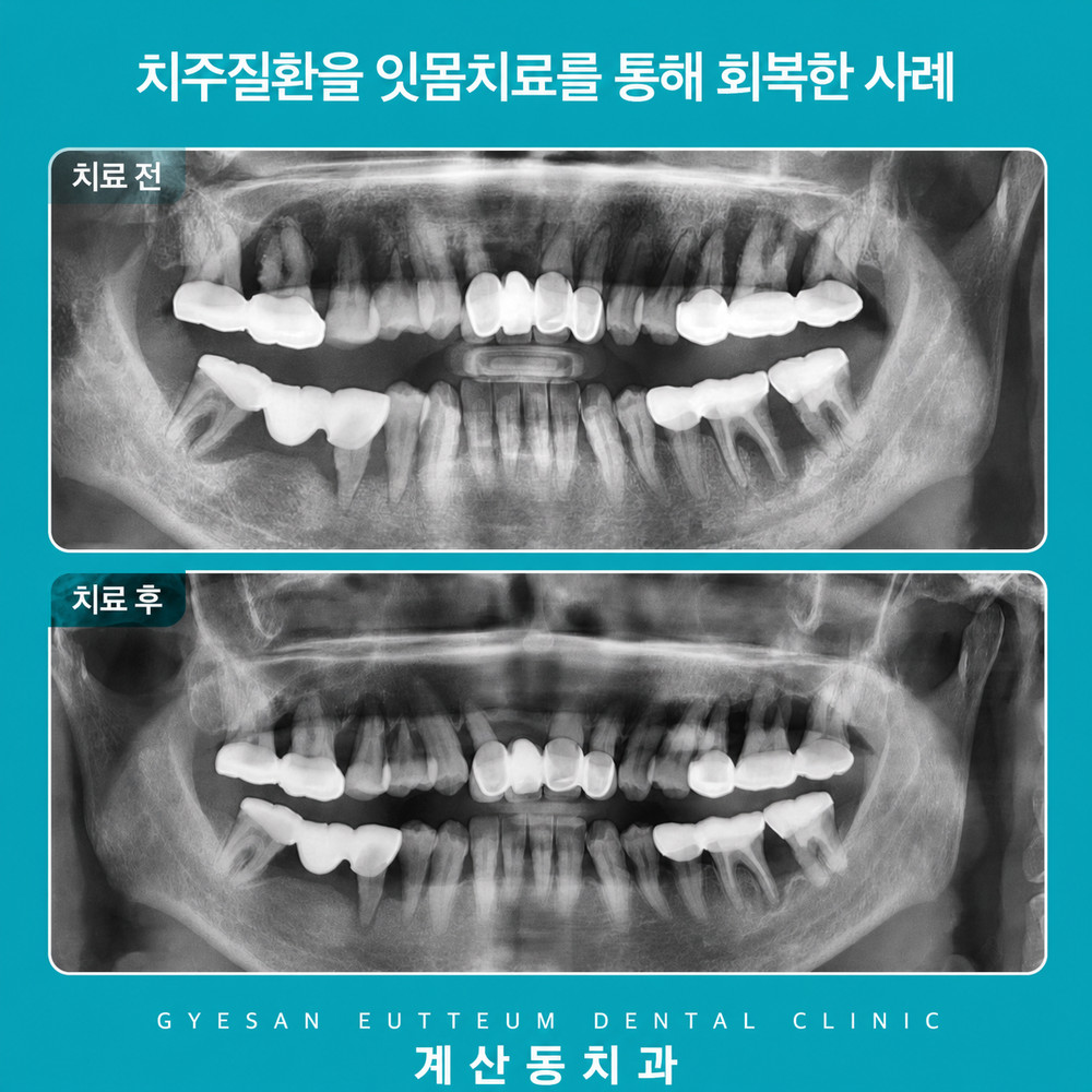 계산동치과 잇몸치료 흔들리는 치아 무조건 발치 전 확인할 주요 판단 기준