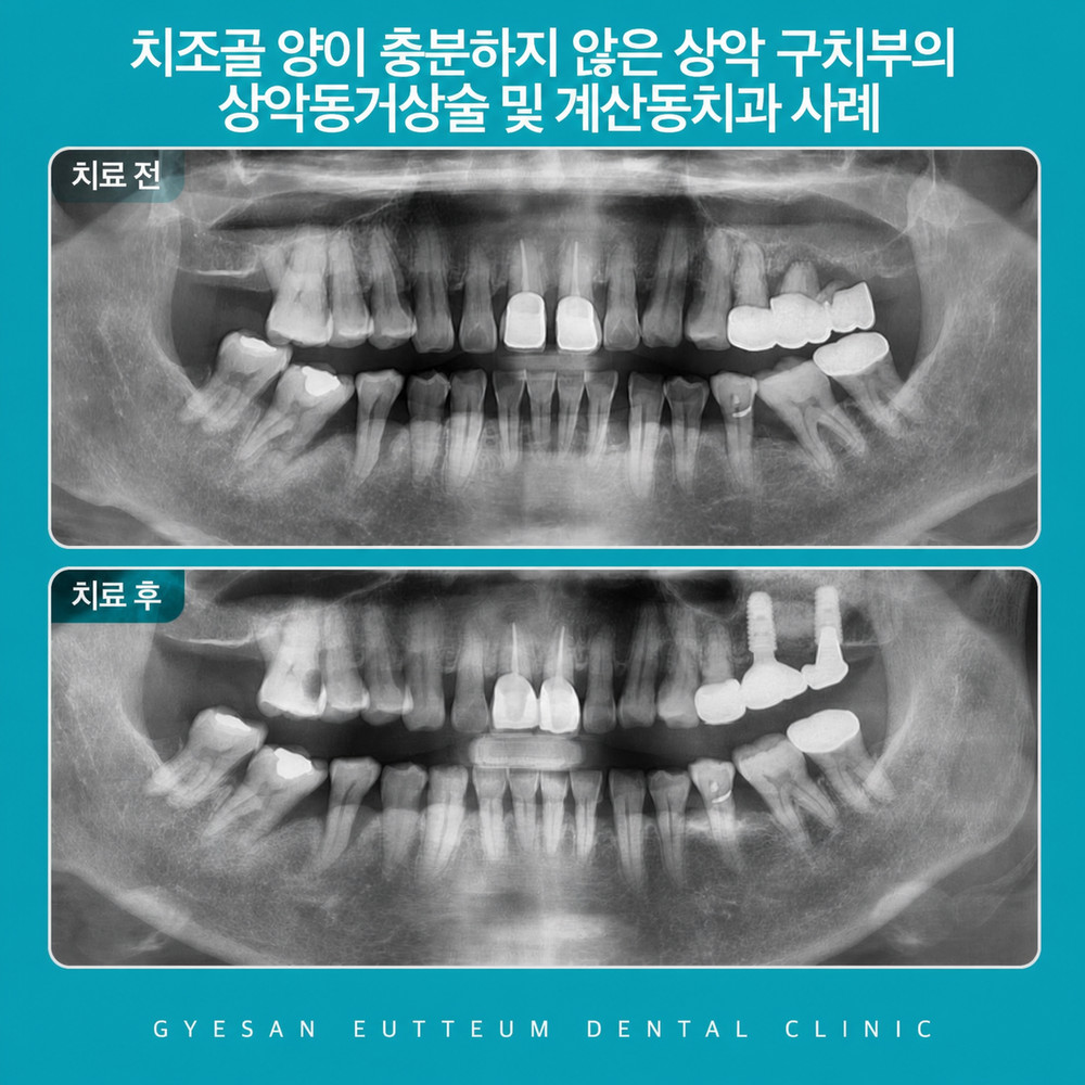 계산동치과 위턱 아래턱 어금니 저작 역할과 임플란트 필요 시점 판단 기준