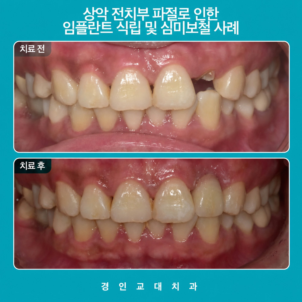 경인교대치과 앞니 파절로 인상과 발음 회복이 필요한 임플란트 치료 판단