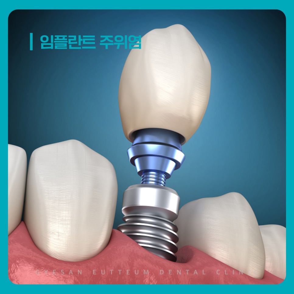계산동치과 임플란트 주변 잇몸 관리 부족과 구강 환경 변화 발생 원인 주의 필요