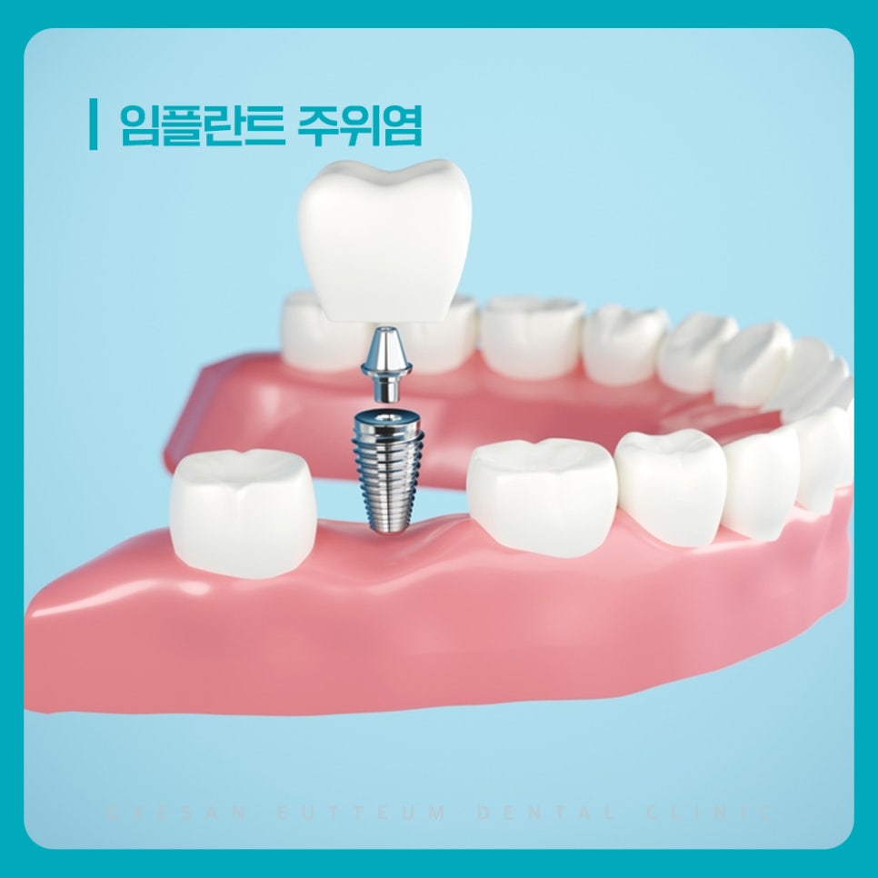 계산동치과 임플란트 주위염 초기 증상 잇몸 붓기 출혈 입 냄새 주의 확인 필요