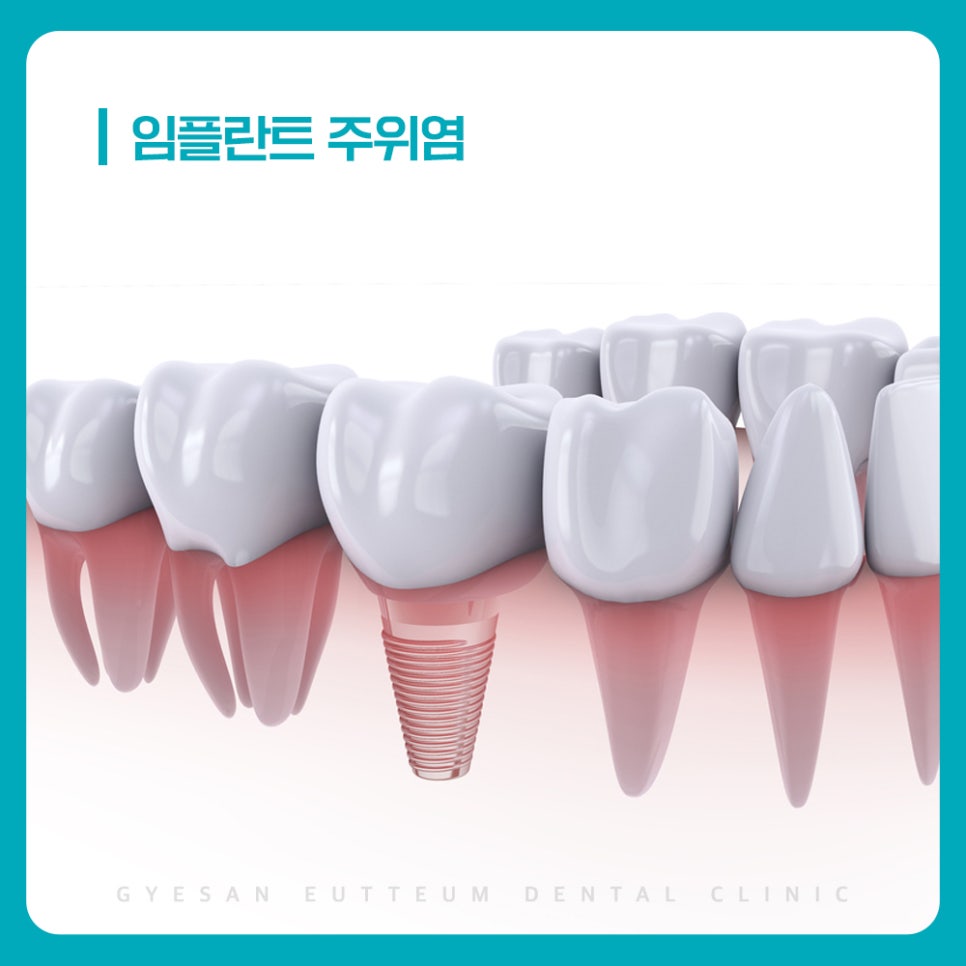 계산동치과 임플란트 관리 어려운 부위별 주위염 진행 속도와 생활 습관