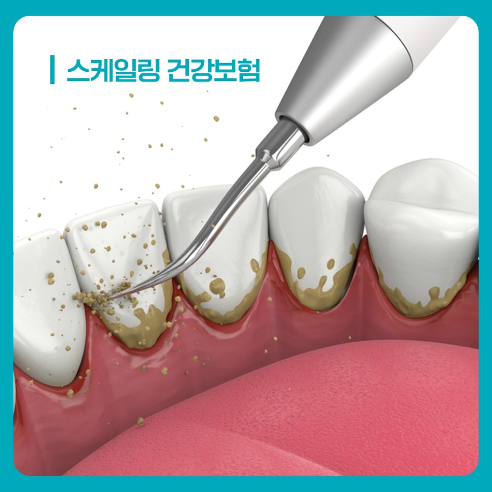 잇몸치료 계획 시 성인 스케일링 건강보험 비용 부담 감소 기준