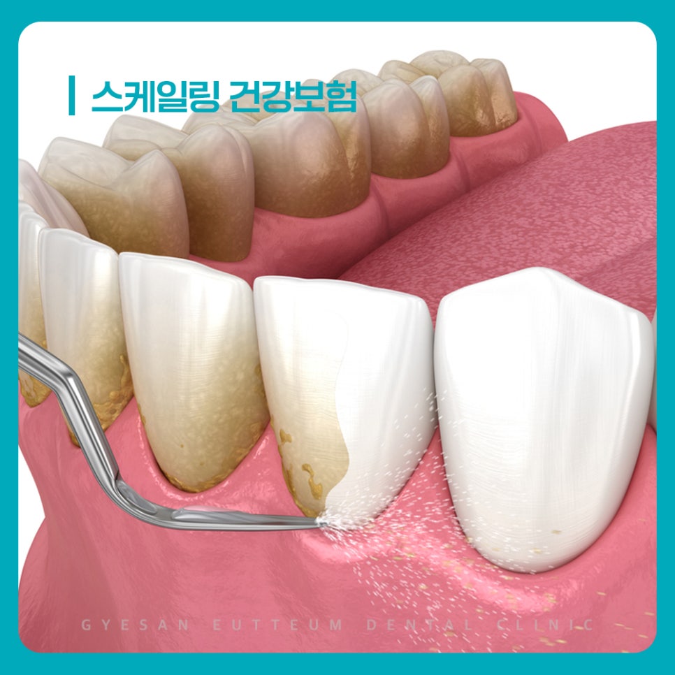 잇몸치료 전 스케일링 건강보험 적용 시기와 횟수 기준 방문 전 확인 방법