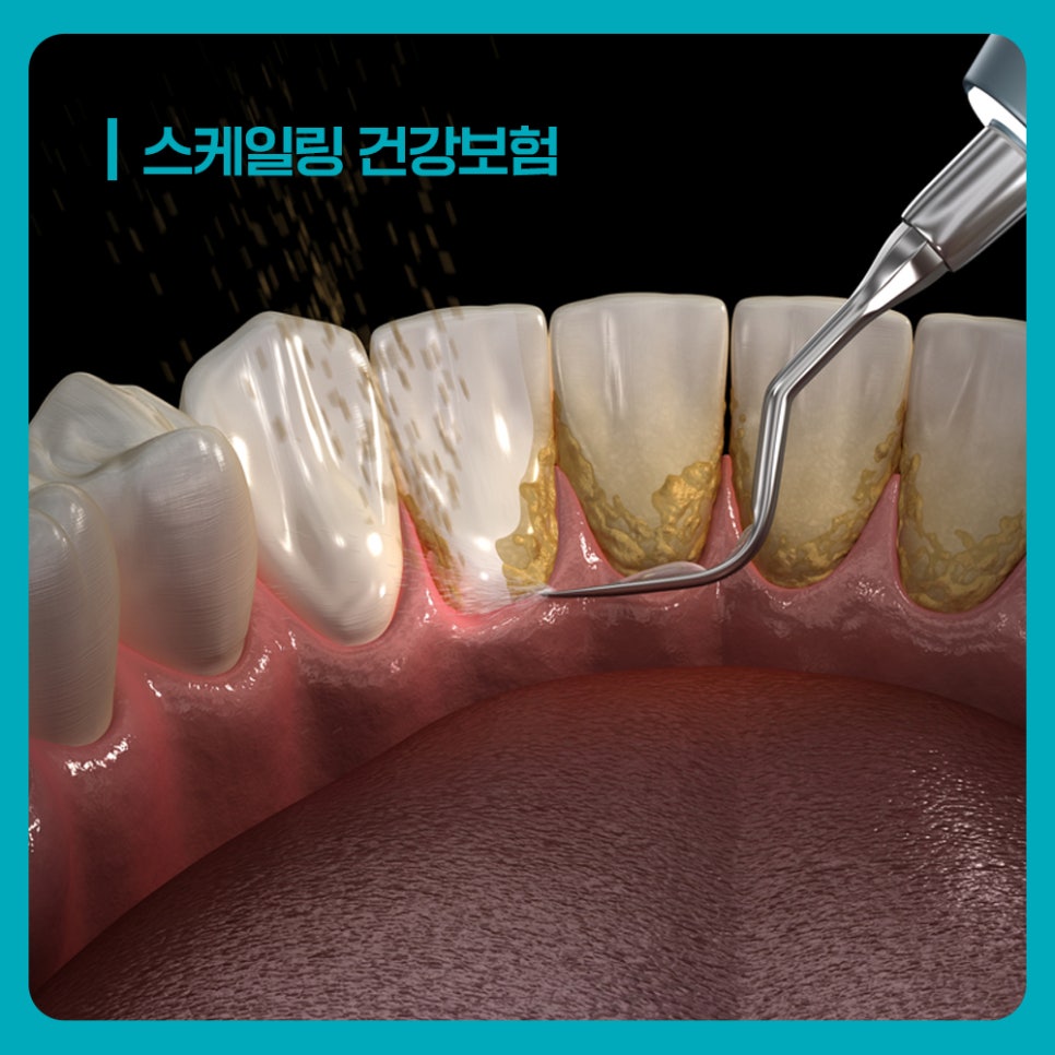잇몸치료 예약 전 스케일링 건강보험 혜택 사용 여부와 마지막 시기 확인