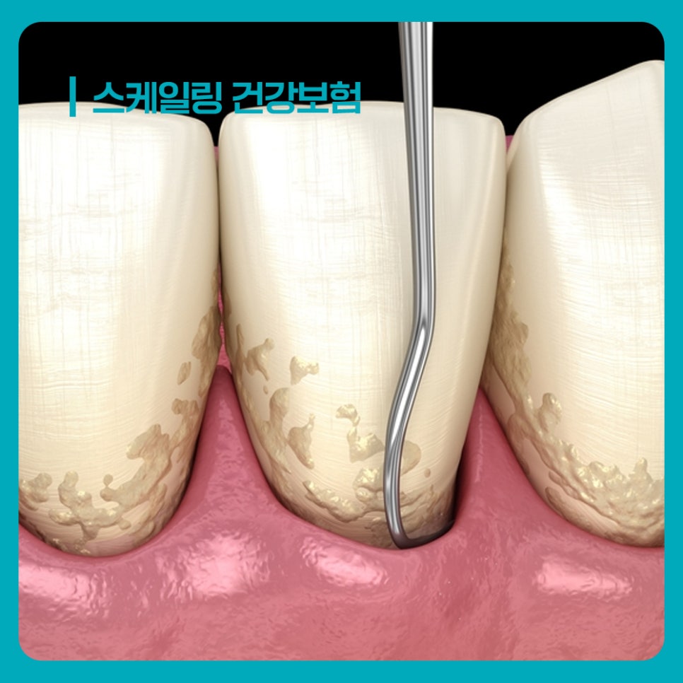 잇몸치료 구강 관리 계획에서 시기 외 치아와 잇몸 상태 확인 주의사항