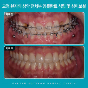 gyesan-dong-dental-implant-1-1