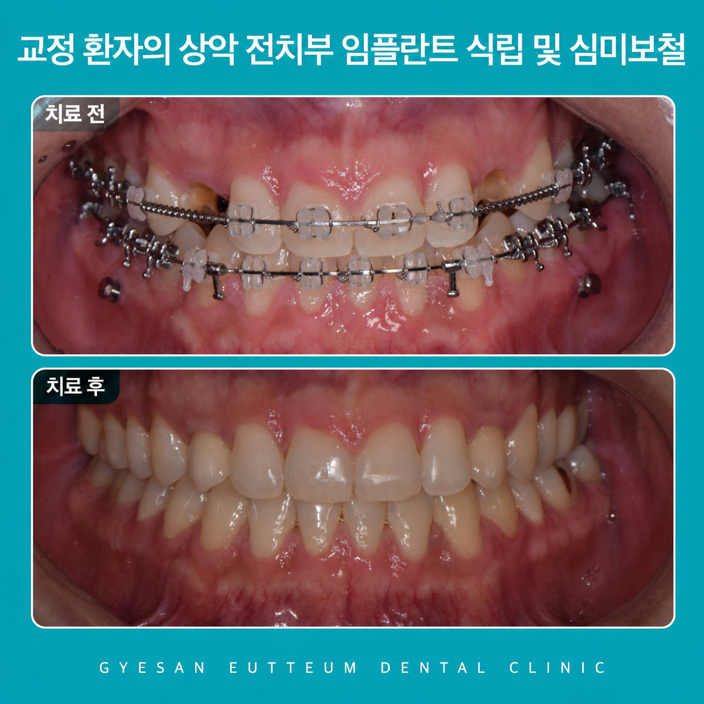 계산동치과 음식을 끊는 기능과 상대방에게 먼저 보이는 심미 관리 중요성 확인