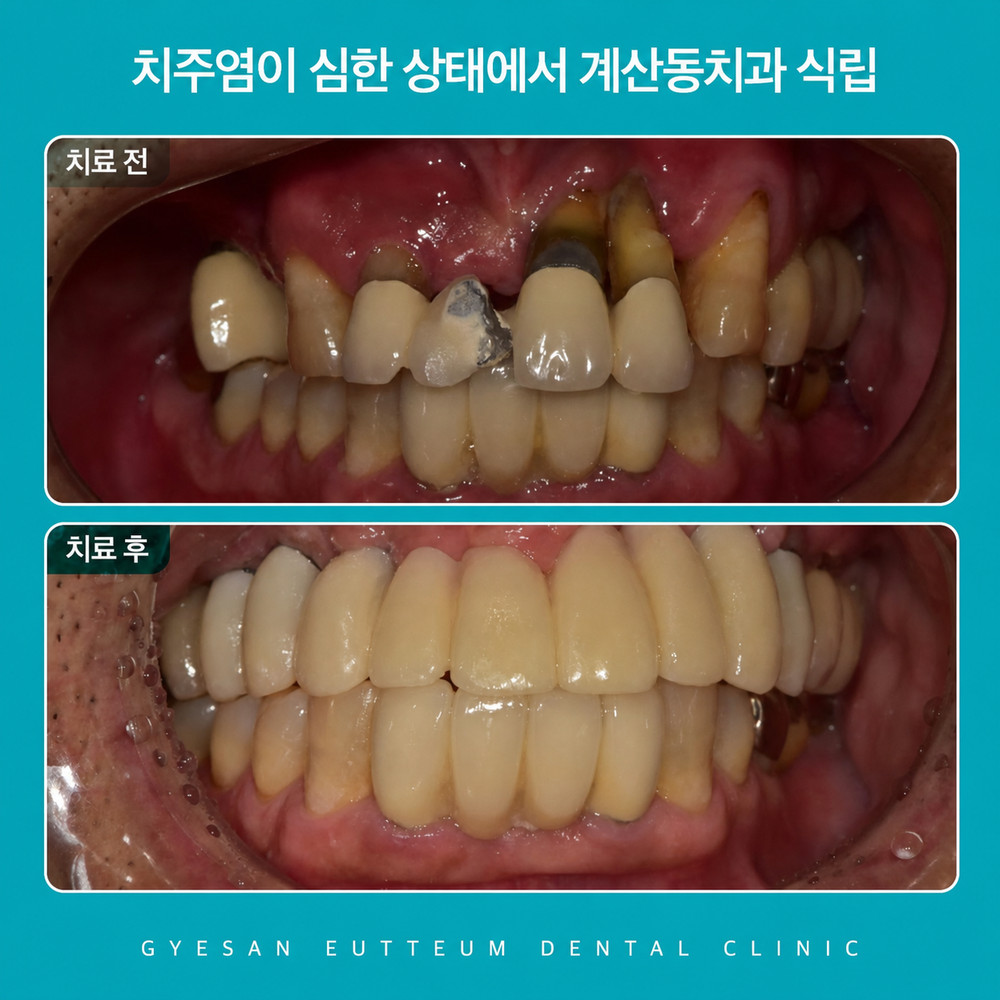 계산동치과 앞니 임플란트 전 잇몸뼈 상태와 심미 치료 기준 확인점 핵심