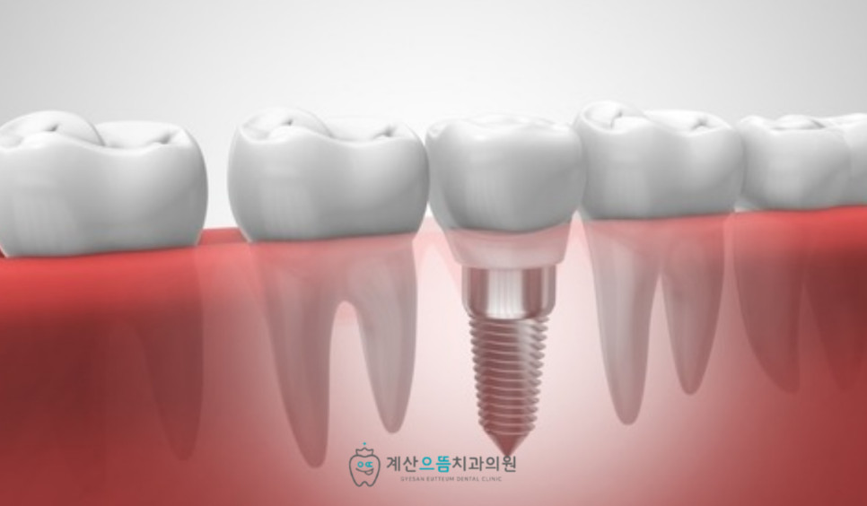 계산동치과 치주염 동반 앞니 상실 임플란트 치료 전 잇몸뼈 진단 확인점