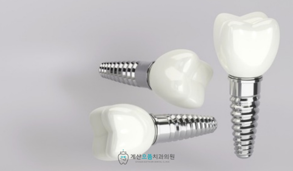 계산동치과 임플란트 식립 안정성을 위한 충분한 잇몸뼈 조건 기준 핵심