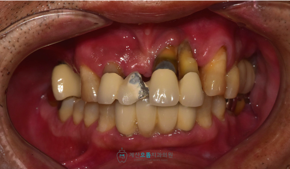 계산동치과 치주염 잇몸뼈 부족 시 임플란트 식립 공간 치료 전 확인점 핵심