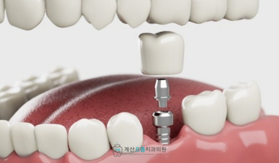 계산동치과 당뇨 환자 임플란트 수술 후 상처 회복과 염증 주의사항 핵심