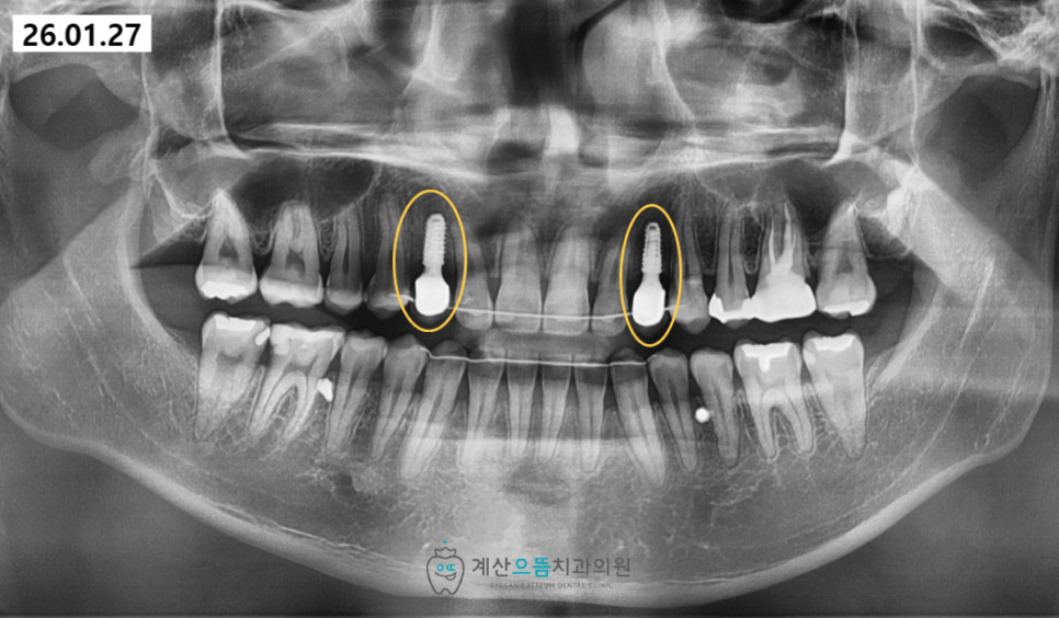 계산동치과 인접 치아 손상 없이 독립 고정력 얻는 임플란트 선호 이유 확인