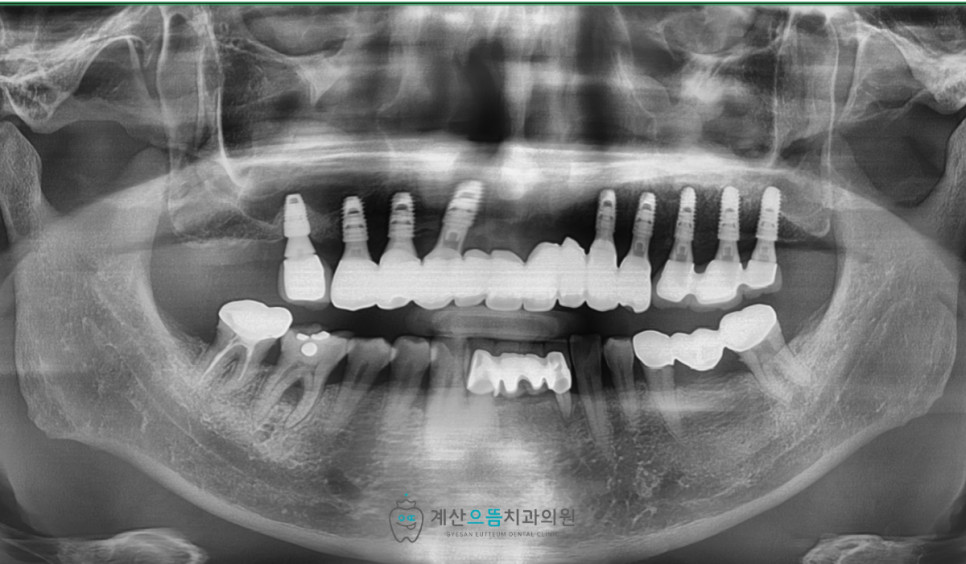 계산동치과 임플란트 보철물 모양과 색상 주변 치아 조화 성공 기준 핵심