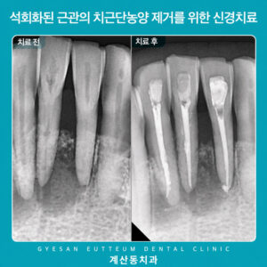 gyesan-dong-root-canal-1