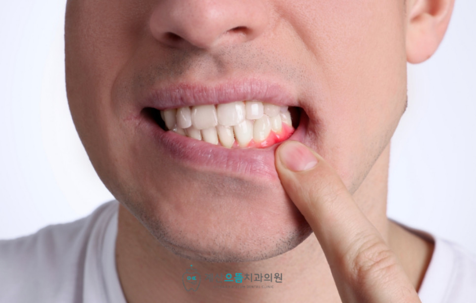 계산동치과 근관 석회화 원인 신경 통로가 좁아지거나 막히는 치료 전 확인