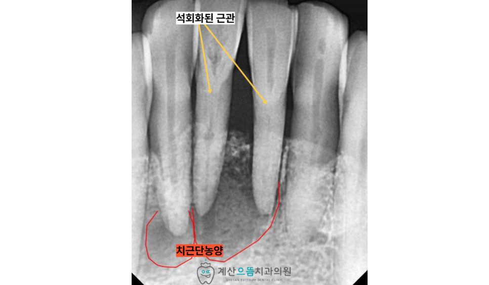 계산동치과 치근단 농양 증상 잇몸 부기와 가만히 있어도 맥박 뛰는 급성 통증