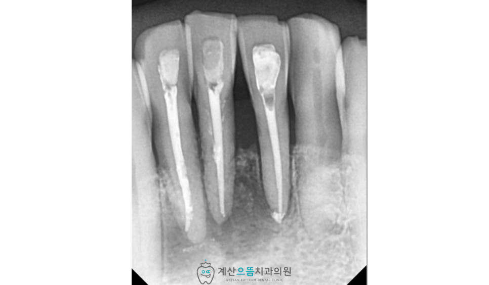 계산동치과 석회화 근관 주의사항 무리한 기구 조작과 치아 옆벽 천공 위험