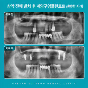 gyeyanggu-implant-overdenture-1