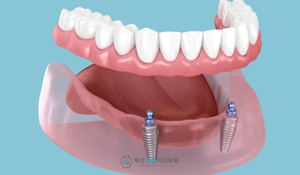계양구임플란트 잇몸뼈 흡수 환자의 틀니 통증과 유지력 약화 주의사항 확인
