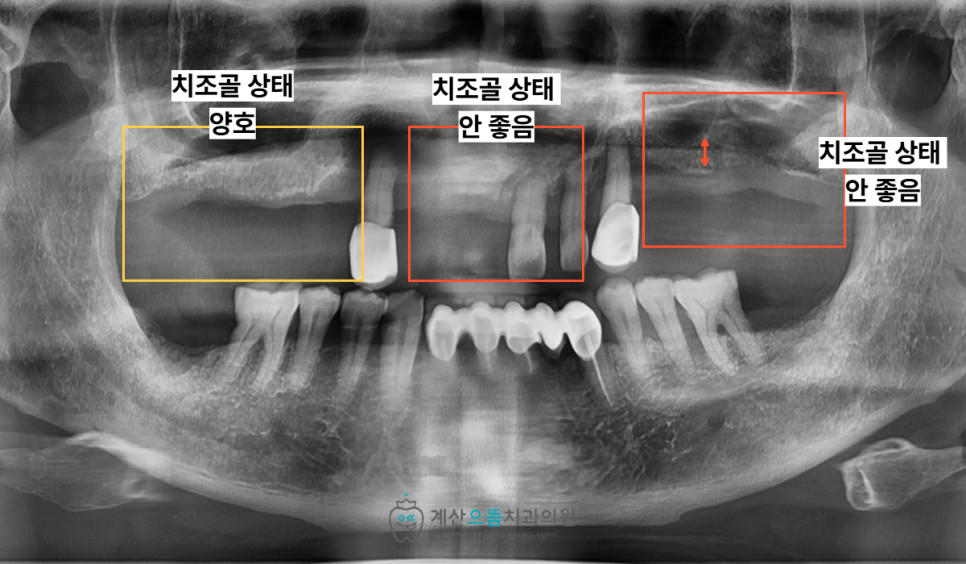 계양구임플란트 치조골이 얇은 무치악 환자 임플란트 공간 부족 문제 주의사항