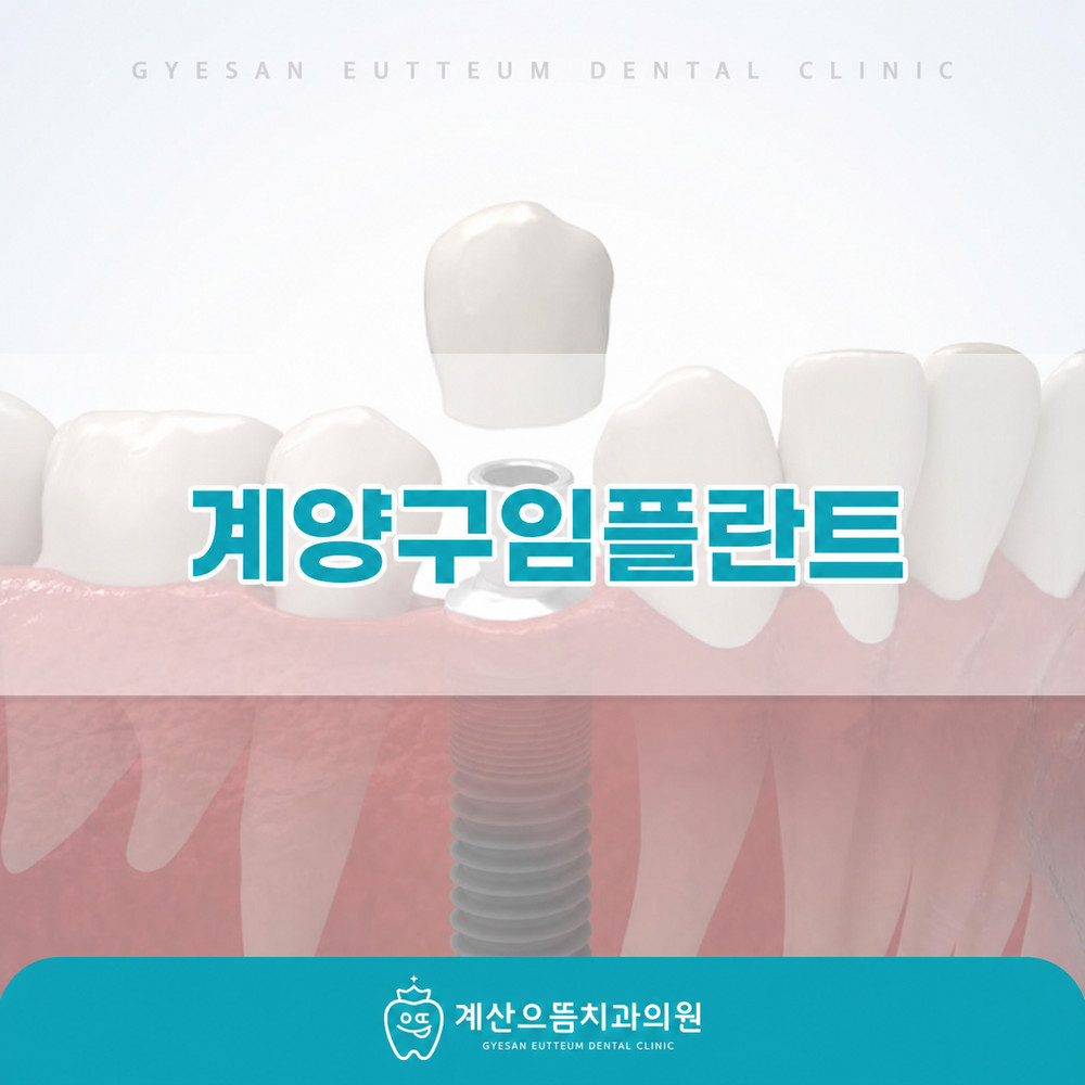 계양구임플란트 전 치아 상실 후 식사 균형과 씹는 방향 변화 초기 주의사항