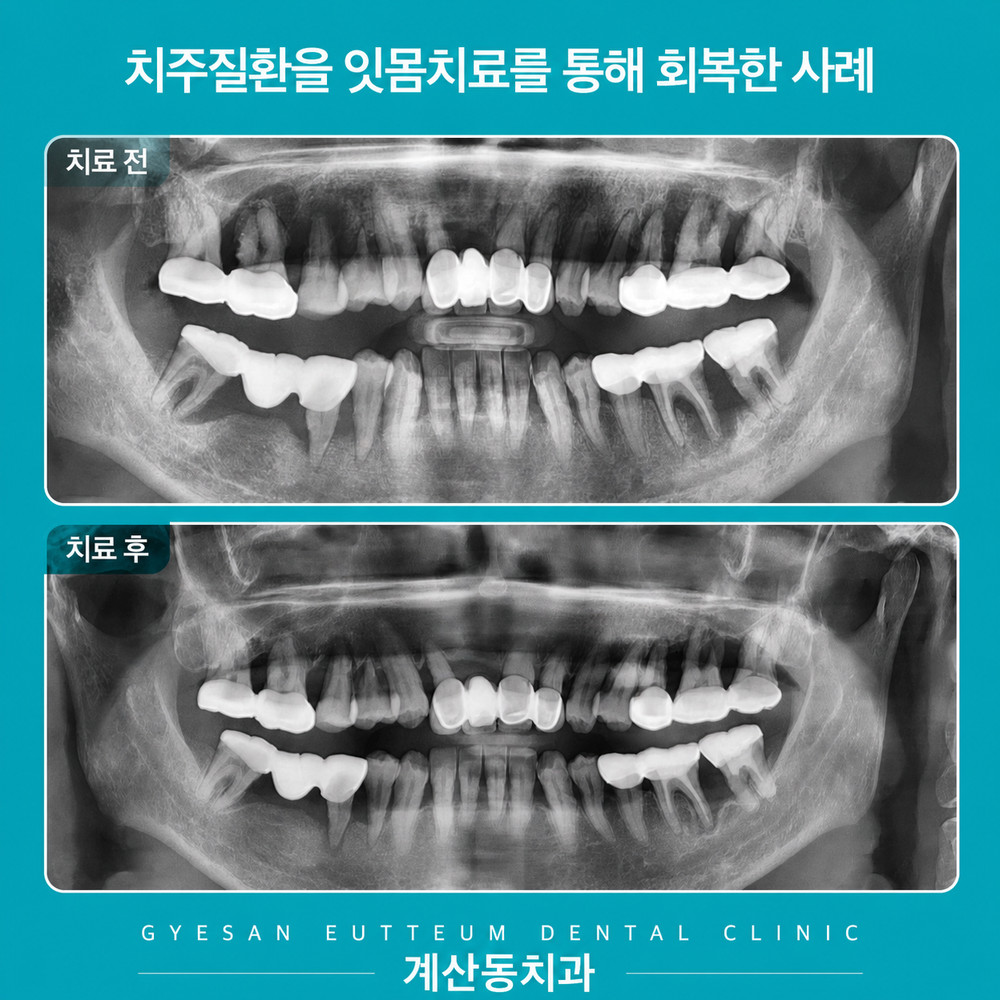 계산동치과 잇몸치료 흔들리는 치아 무조건 발치 전 정확한 잇몸뼈 상태와 필요성 확인