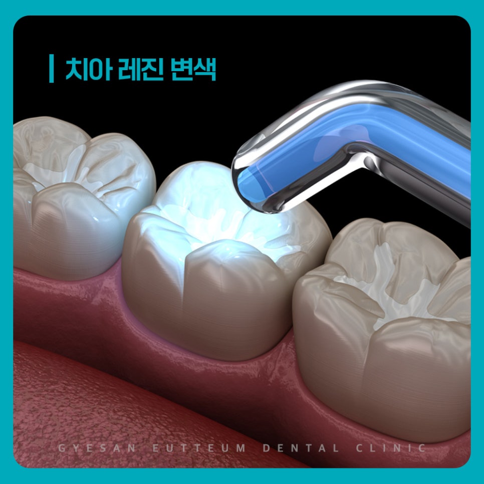 경인교대치과 치아 레진 변색 원인 커피 차 와인 흡연 착색 생활습관 주의사항